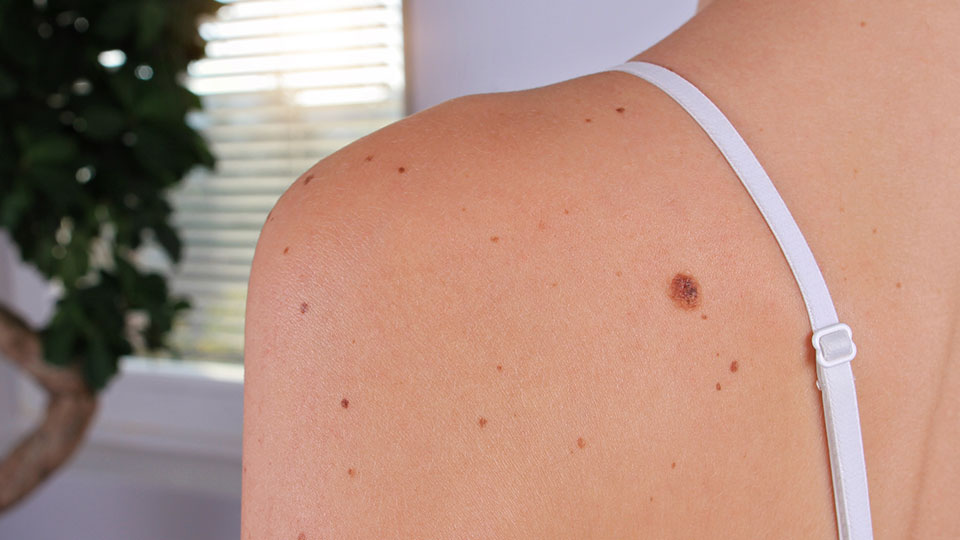 skin tags removal home
