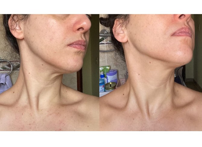 Gold Bond Neck Firming Cream Before & After