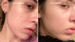 @tetka_beauty on TikTok showing the before and after of using Anua's 10% Niacinamide + 4% Tranexamic Acid Dark Spot Correcting Serum for two weeks. The before is on the left side and the after is on the right side.