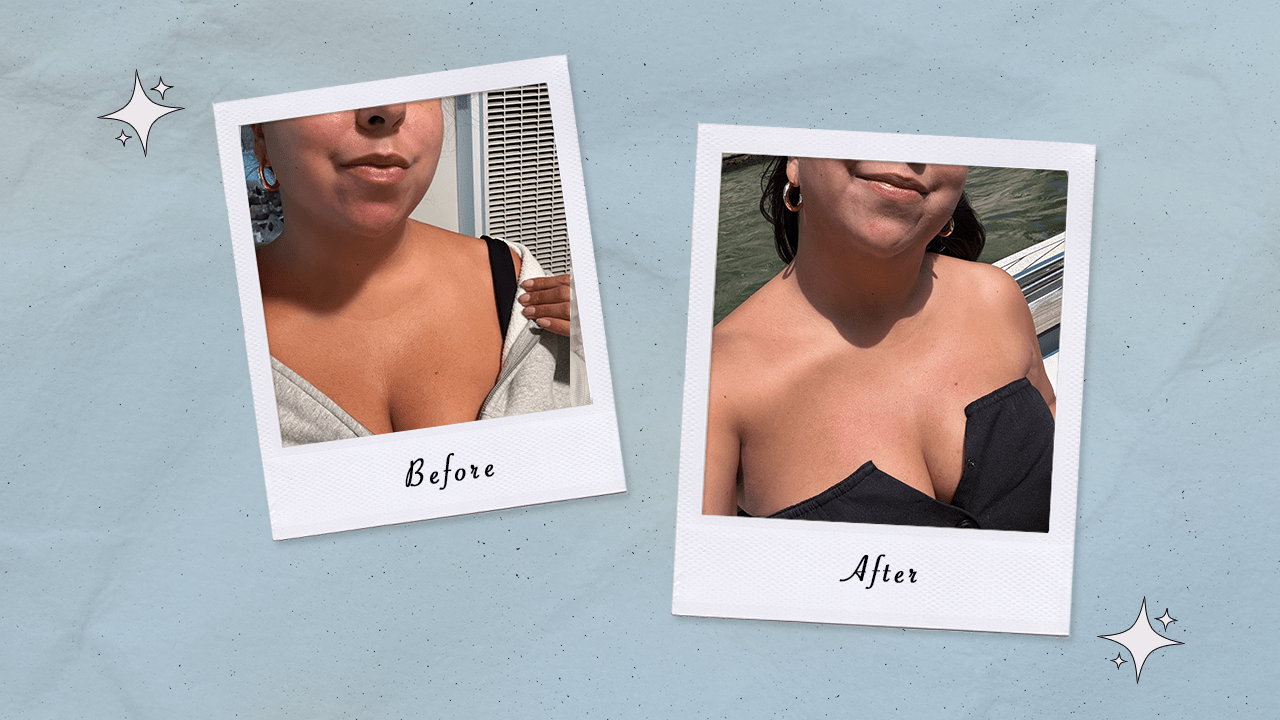 Before and after photos of Sam's results from using Solawave's neck and chest red light therapy mask